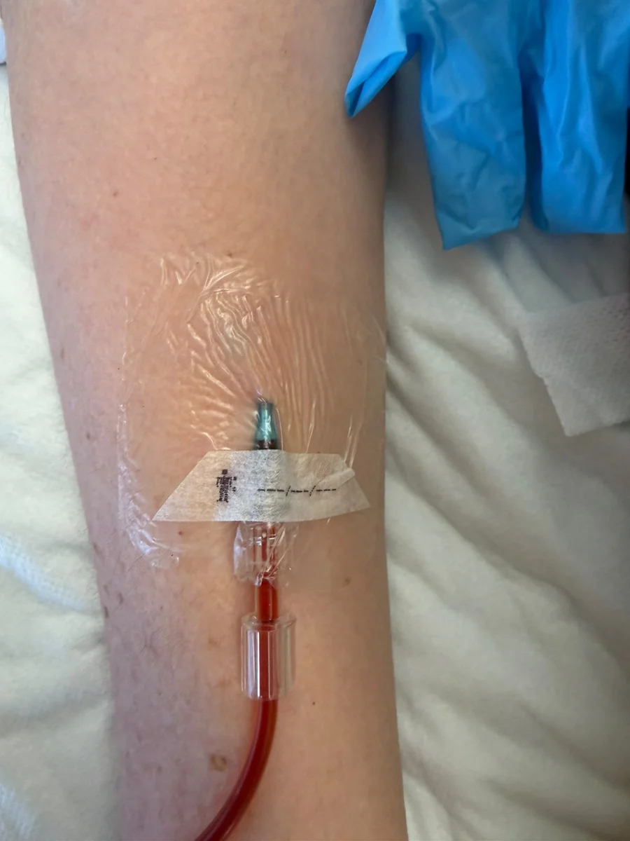 An IV cannula secured with a transparent dressing on an arm