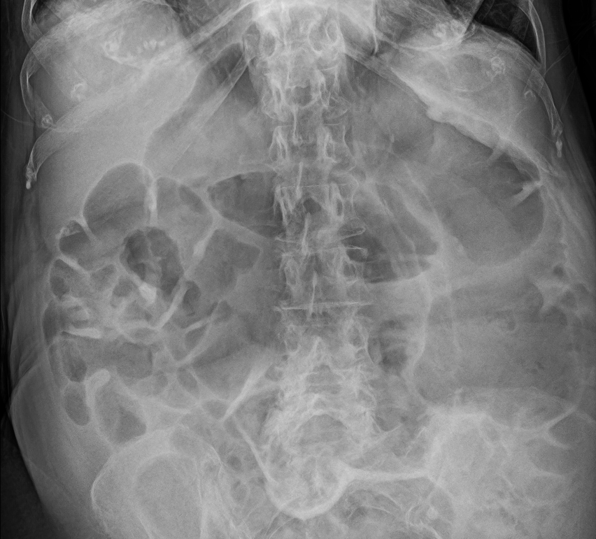 Abdominal X-ray example