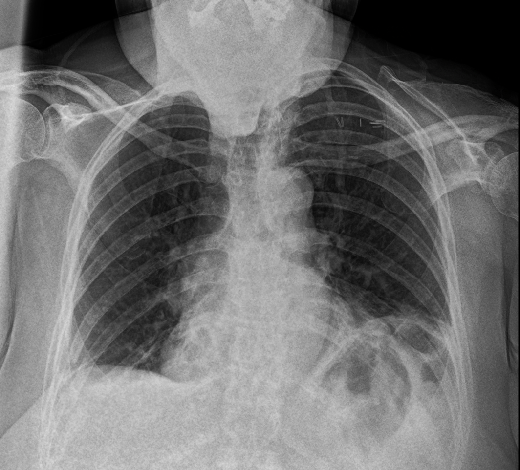 Chest X-ray example