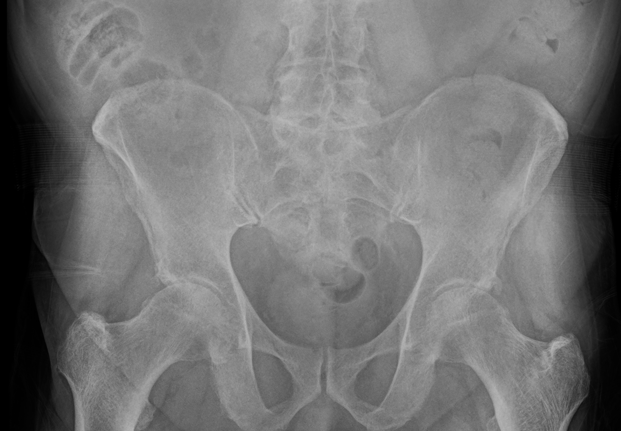 Pelvis and Hip X-ray example