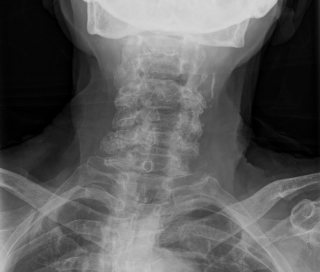 Spine X-ray example